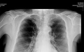 La causa principale dell'embolia polmonare è la trombosi venosa periferica (spesso della circolazione venosa degli arti. Http Web2 Sacrocuore It Oncologia Oncologia 21sett15 Dalla Chiara Pdf