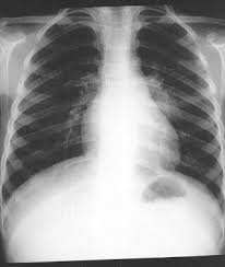 Case contributed by dr brenda lee solorzano frontal chest x ray shows bilateral micronodular insterstitial effusion. Tuberculosis