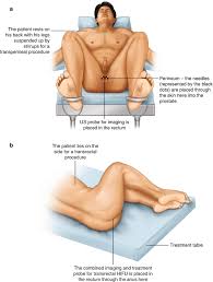 Prostate massage could be the answer to your prayers! Focal Therapy For Prostate Cancer A Guide For Patients Springerlink