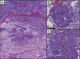 Bevacizumab for newly diagnosed pleural mesothelioma in the mesothelioma avastin cisplatin pemetrexed study (maps): Three Dimensional Histologic Immunohistochemical And Multiplex Immunofluorescence Analyses Of Dynamic Vessel Co Option Of Spread Through Air Spaces In Lung Adenocarcinoma Journal Of Thoracic Oncology