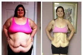 The rny has recently been reported to increase the need for hospitalization for complications after rny surgery. Tennessee Teen Launches Second Crowdfunding Campaign Through Gofundme For Skin Surgery