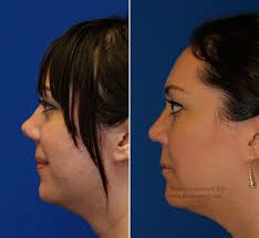 Rhinoplasty Patient 46 Before And After Left Profile Upturned Nose Repair Lamperti Upturned Nose Rhinoplasty Nose Job