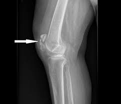 Image result for Osteomyelitis XRay