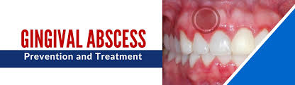 Image result for Periodontal Abscess