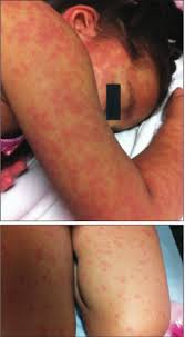Image result for Generalized Rash