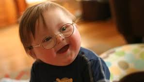 Presencia de un cromosoma extra en el par 21, por esta razón se le llama trisomía 21. Sindrome De Down Definicion Tipos Causas Sintomas Y Tratamientos