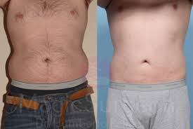 Image result for Liposuction