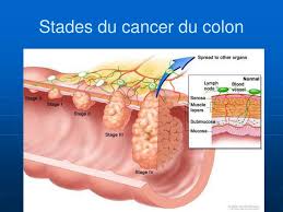 Cancer de lanus l4homme ideal guerlain de survie. Ppt Cancer Colo Rectal Powerpoint Presentation Free Download Id 3297679