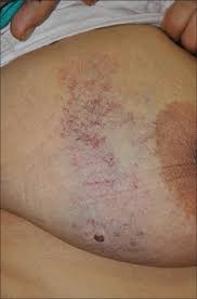 • identification of petechiae and purpura • think through broad differential • inpatient vs outpatient management • history and exam to narrow differential and workup. Late Onset Angioma Serpiginosum Of The Breast With Co Existing Cherry Angioma Abstract Europe Pmc