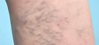 Panas throbbing, kekejangan malam, sakit ketika berjalan, sakit semasa batang (rcmo) dalam, am rasa sakit dan aching kaki tangan. Vena Varikos Dan Kehamilan Dr R Juhaidah Blog