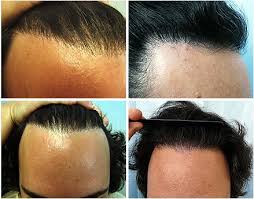 Online hair transplant reviews ✅ clinics scored based on price, history and customer satisfaction ✅ check the top rated hair transplant clinics! Hairline Hair Transplantation Using Ugraft Fue