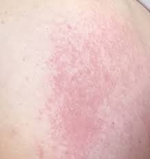 Image result for heat rash under breasts