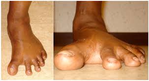 Image result for Hallux Varus
