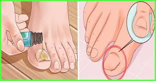 11 home remes for toenail fungus