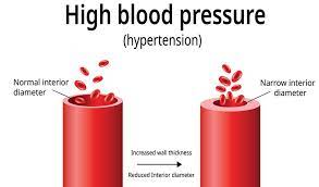 Stroke Rounds Aspirin Overused For Primary Prevention