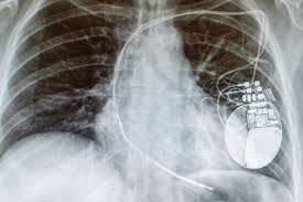 You can use 'message the moderators' button for anything else in your also defibrillators release a very sudden, very strong discharge while teasers and stun guns release lower, constant discharges. Steps To Travelling With A Pacemaker Or Defibrillator Icd Melbtravel
