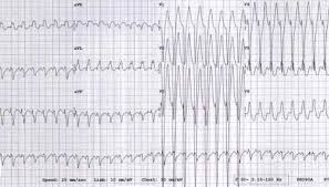 Vt Versus Svt Litfl Medical Blog Ecg Library Basics Palpitations Pr Interval Brugada Syndrome