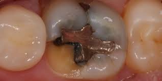 We did not find results for: How Long Do Dental Fillings Last Dental Health Society