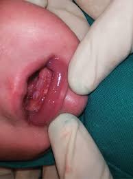 Image result for Neonatal Teeth
