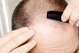 Ketoconazole shampoo is commonly advertised as a dandruff treatment, with otc brands like nizoral available in supermarkets or online for purchase. Can Ketoconazole Shampoo Dandruff Shampoo Regrow Hair