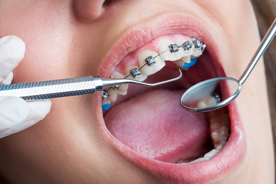 Orthodontic procedures with braces and aligners product image