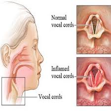 Effective Natural Remedies For Laryngitis Ginger Apple Cider Vinegar Eucalyptus Honey Home Remedies For Laryngitis Home Health Remedies Laryngitis Remedies