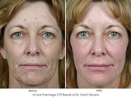 While a jowl lift surgery is considered to be the most effective sagging jowls treatment, there are many drawbacks to surgery. Turn Back The Clock With These 2 Skin Tightening Facelift Alternatives