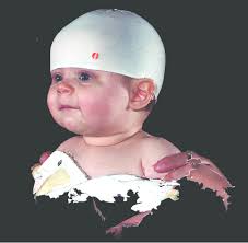 2D illustration of the composed 3D image of the patient's head, which...