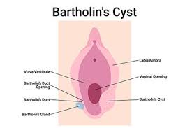 Image result for Bartholin's gland abscess