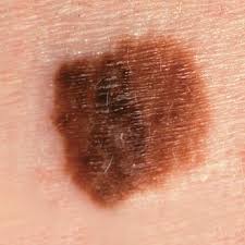 Some patients may have hundreds of seborrhoeic keratoses. Mole Or Skin Cancer Health Com