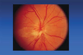 This may result in a varying spectrum of disorders ranging from ischemia to infarction with. Visual Loss In Neuro Ophthalmology Intechopen