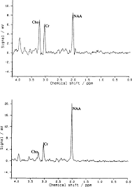Aspartoacylase An Overview Sciencedirect Topics