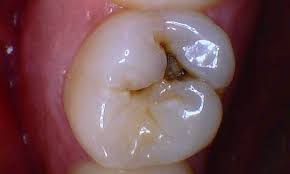 Maybe you would like to learn more about one of these? Tooth Colored Fillings Cavity Treatment Durham Nc Cavity Fillings