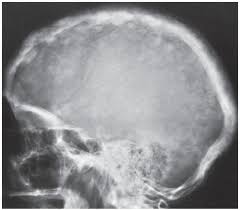 Paget Disease Radiology Key