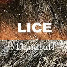 Image result for lice vs dandruff
