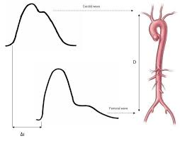 Doppler Ultrasound In The Measurement Of Pulse Wave Velocity