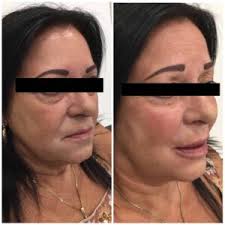 Lip Fillers and Dermal fillers