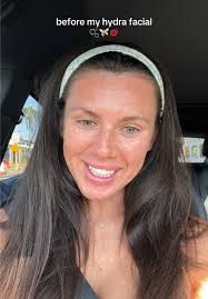 Hydrafacial Experience at My Favorite Medspa