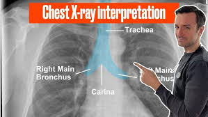 Image result for Chest XRay Interpretation