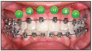 Bracket Positioning For Smile Arc Protection Jco Online