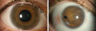 Der erhöhte innere augendruck führt zur druckschädigung innerer augenstrukturen. Kindliches Glaukom Augenklinik Saar Sulzbach