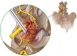 Check spelling or type a new query. Multizyte Facet Indikation Schmerzbehandlung Joimax Gmbh