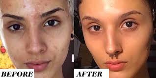 For optimal skin benefits, barr suggests supplementing with vitamin c* and applying it topically. This Woman S Before And After Retinol Results Are Going Viral On Reddit