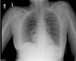 Chest X Ray Review 1 Flashcards Quizlet
