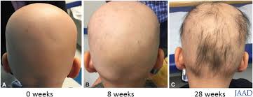Alopecia universalis is often shortened to au and it also goes by the name alopecia areata universalis. Jaad Journals On Twitter Topical 2 Tofacitinib For Children With Alopecia Areata Alopecia Totalis And Alopecia Universalis Https T Co M4wn5ridpr Https T Co Cqojp6kuav
