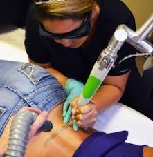 Tattoff provides professional laser tattoo removal with clinics in california, texas and arizona. Houston Laser Tattoo Removal New Look Laser Tattoo Removal