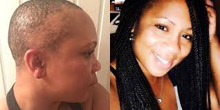 Do you suffer from hair loss and baldness? This Woman Turned Traction Alopecia Into A Lesson In Self Care