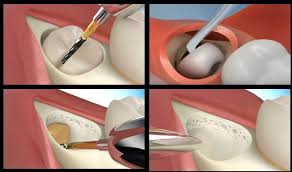 • bleeding that goes beyond 24 hours after the surgery. Wisdom Tooth Surgical Removal Teeth Extraction Treatment Infected Wisdom Iv Sedation Chester Deva Dental Clinic