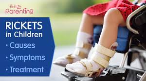 Image result for Rickets