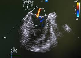 Phosphorus P Element Symbol From Periodic Table Series 3d Rendering Isolated O Aff Periodic In 2020 Mitral Valve Regurgitation Mitral Valve Stock Illustration